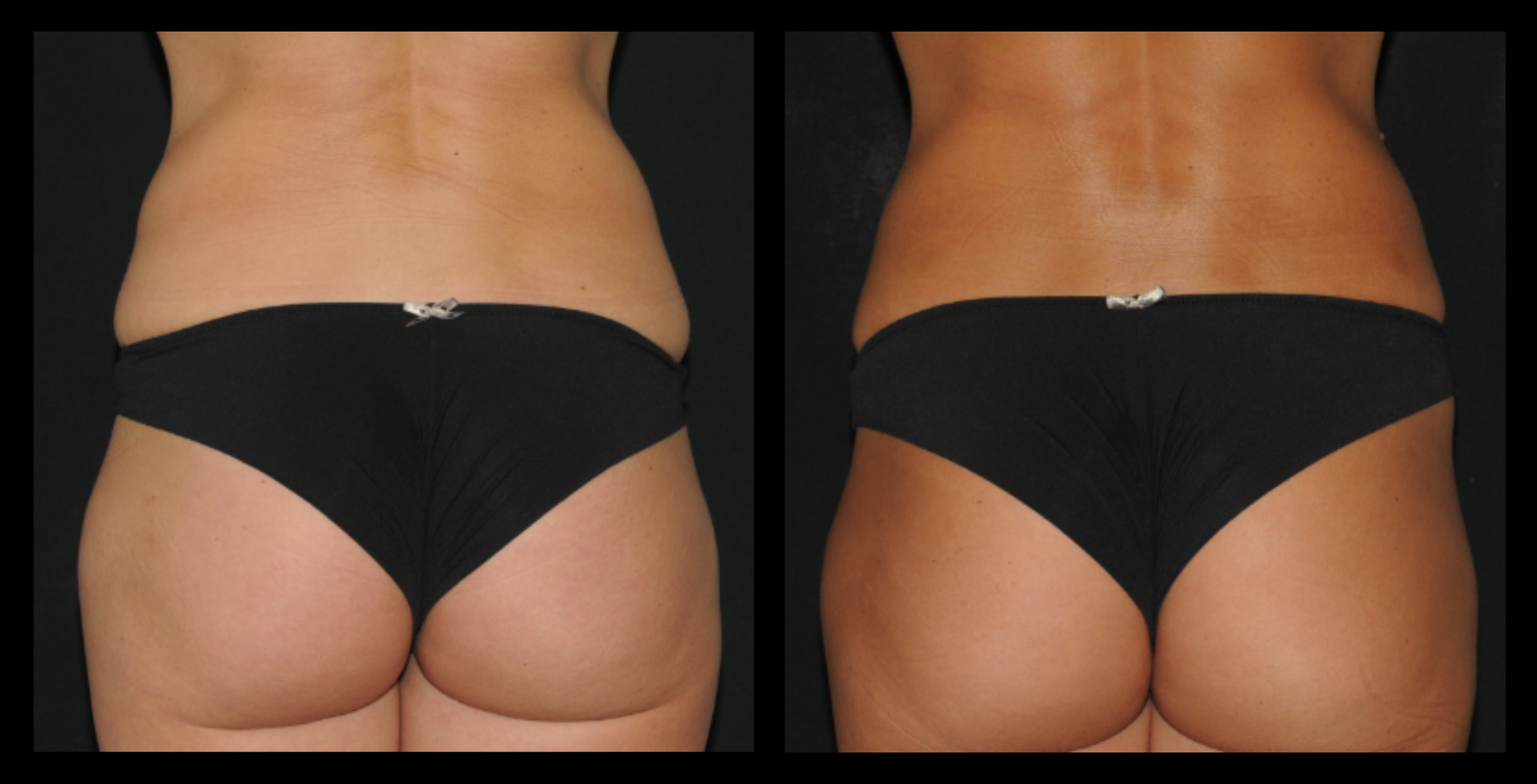 Before and after image showing significant fat reduction in the flanks following 3 medical-grade fat reduction machine treatments. Photo courtesy of Lightfective.