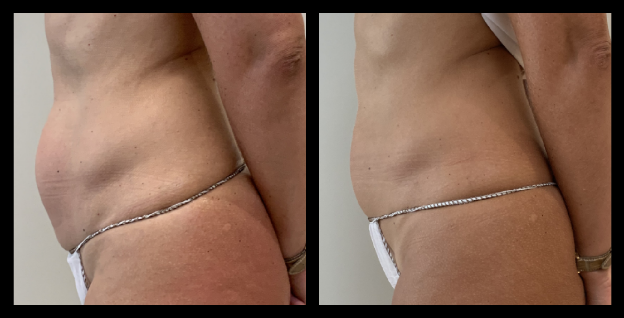 Before and after results of medical-grade fat reduction machine treatment on the abdomen after 3 non-invasive body contouring sessions. Visible reduction in abdominal fat. Photo courtesy of Lightfective.