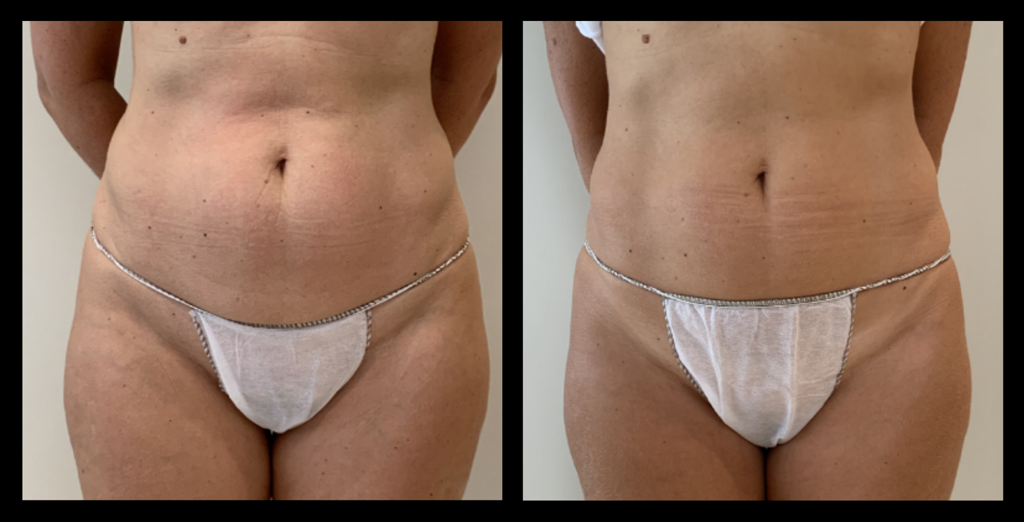 Before and after comparison of abdominal fat reduction following 4 medical-grade body contouring treatments. Noticeable slimming and improved abdominal definition. Photo courtesy of Lightfective.