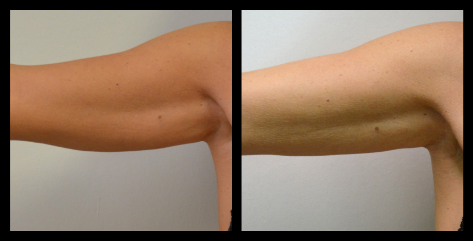 Before and after results showing visible arm fat reduction after 1 medical-grade fat reduction machine treatment. Improved contour and slimmer upper arms. Photo courtesy of Lightfective.