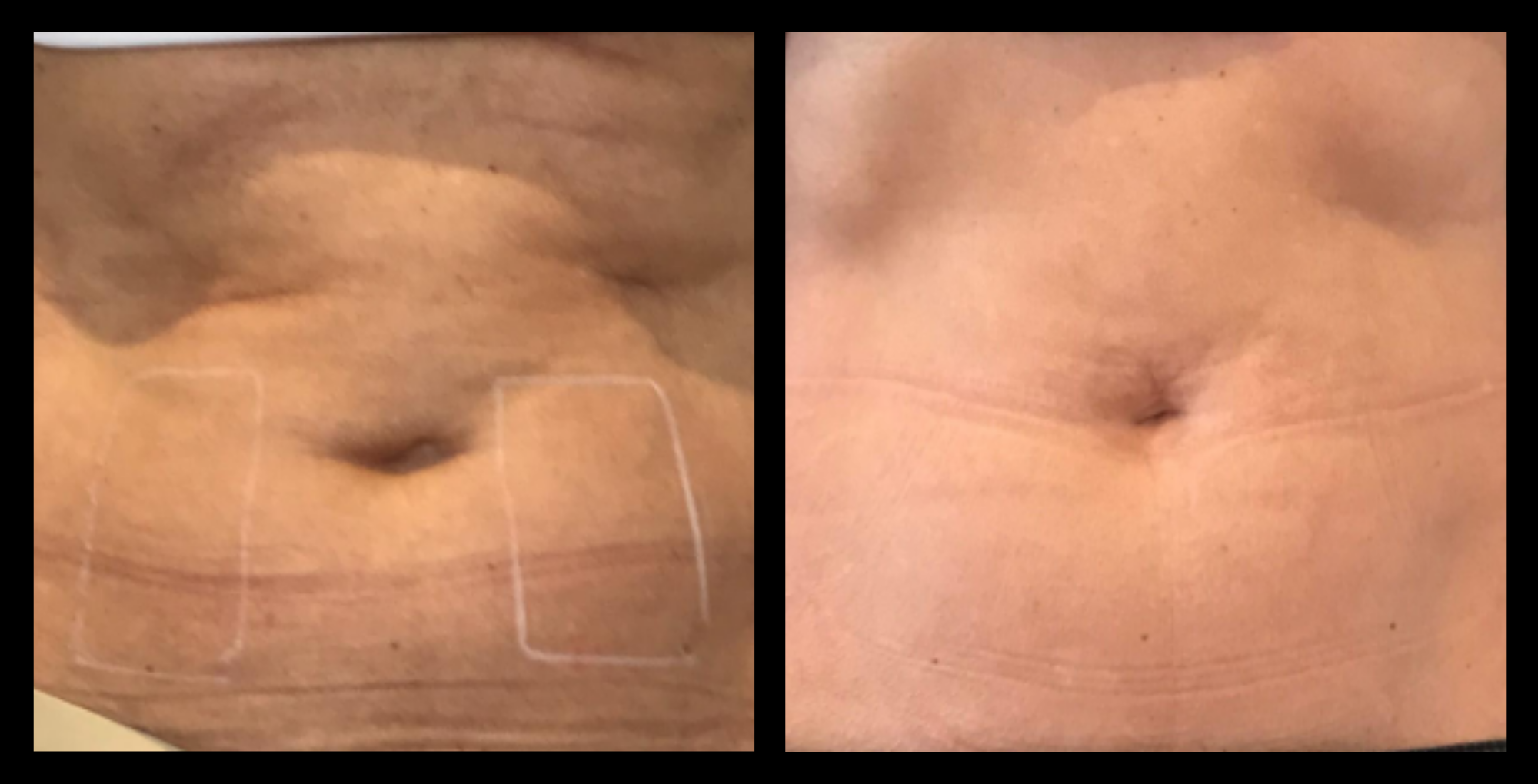 Before and after results of abdominal fat reduction after 2 medical-grade fat reduction machine treatments. Noticeable slimming and improved contour in the stomach area. Photo courtesy of Lightfective.