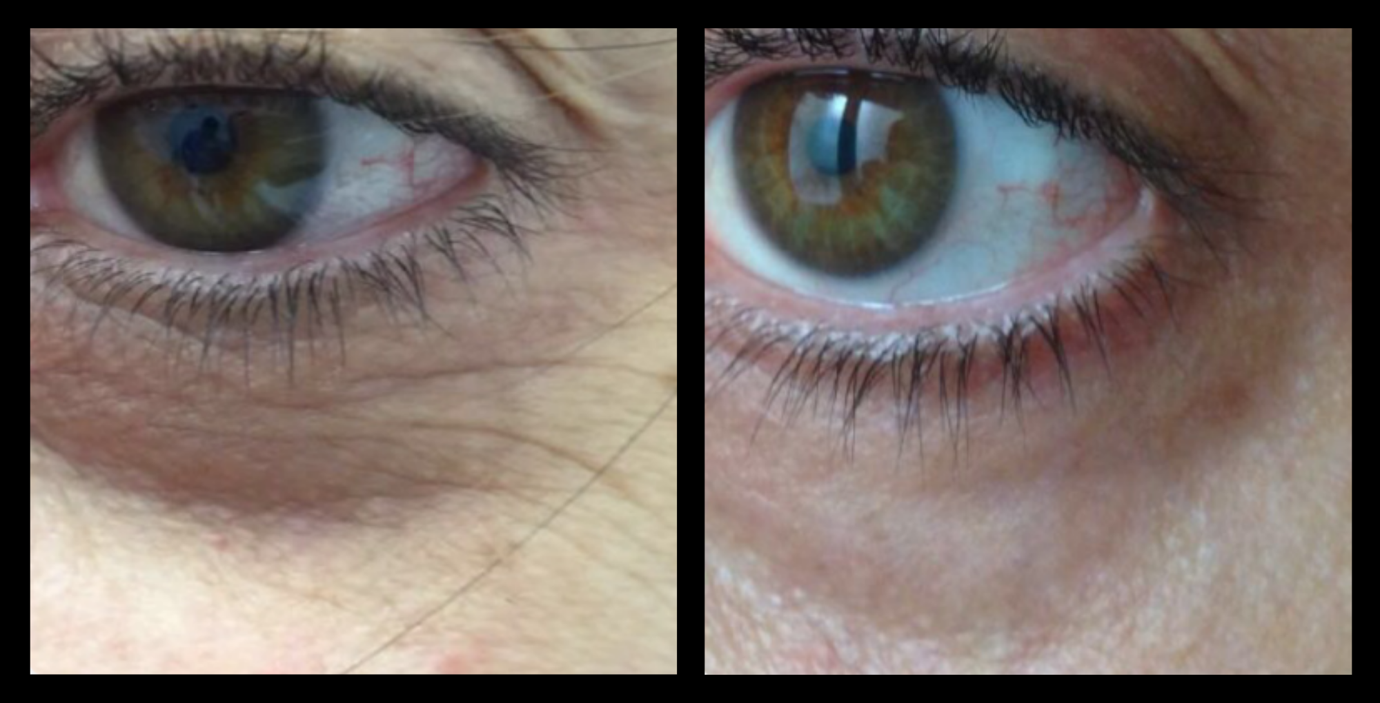 Before and after periorbital treatment results showing reduced under-eye bags and smoother eye contour using advanced skin technology by GMV, Italy.