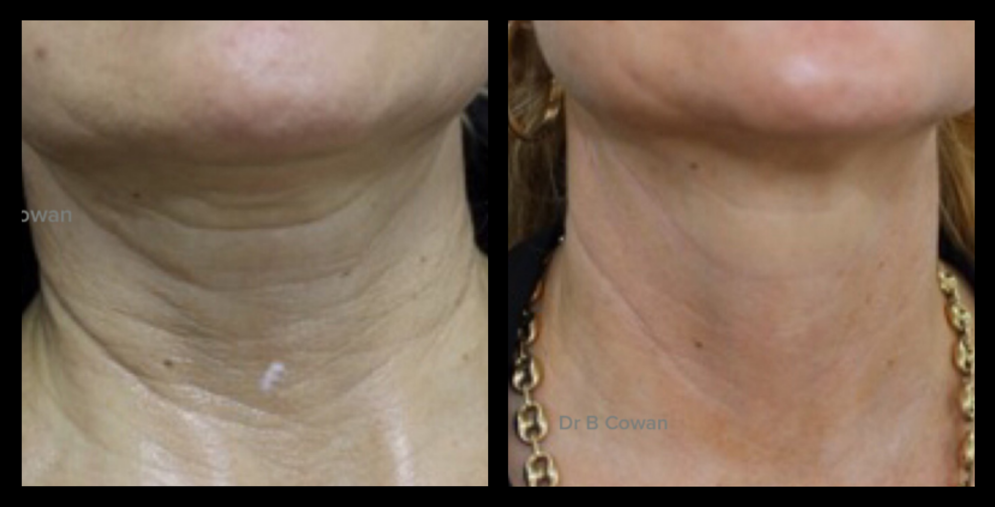 Before and after results of Plasma Skin Rejuvenation treatment showing improved skin texture and reduced fine lines, performed using GMV technology in Italy.