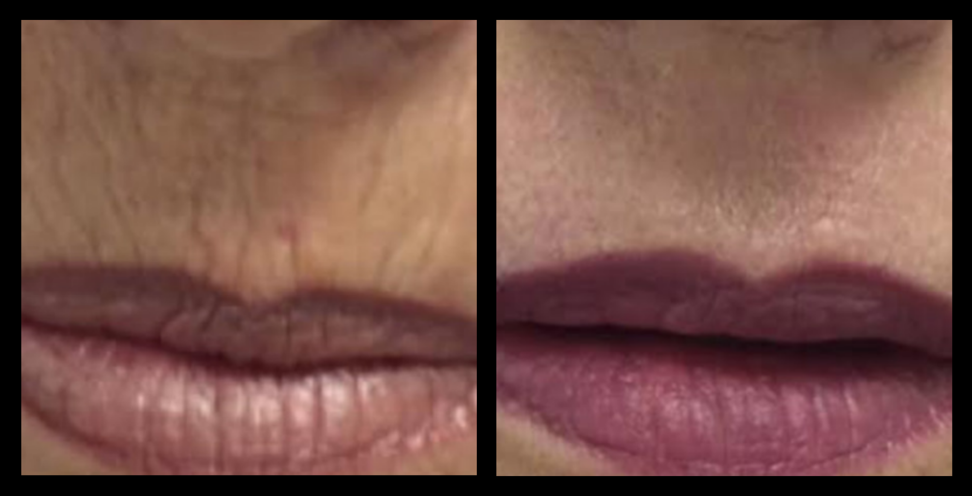 Before and after results of Plasma Skin Rejuvenation treatment showing improved skin texture and reduced fine lines, performed using GMV technology in Italy.