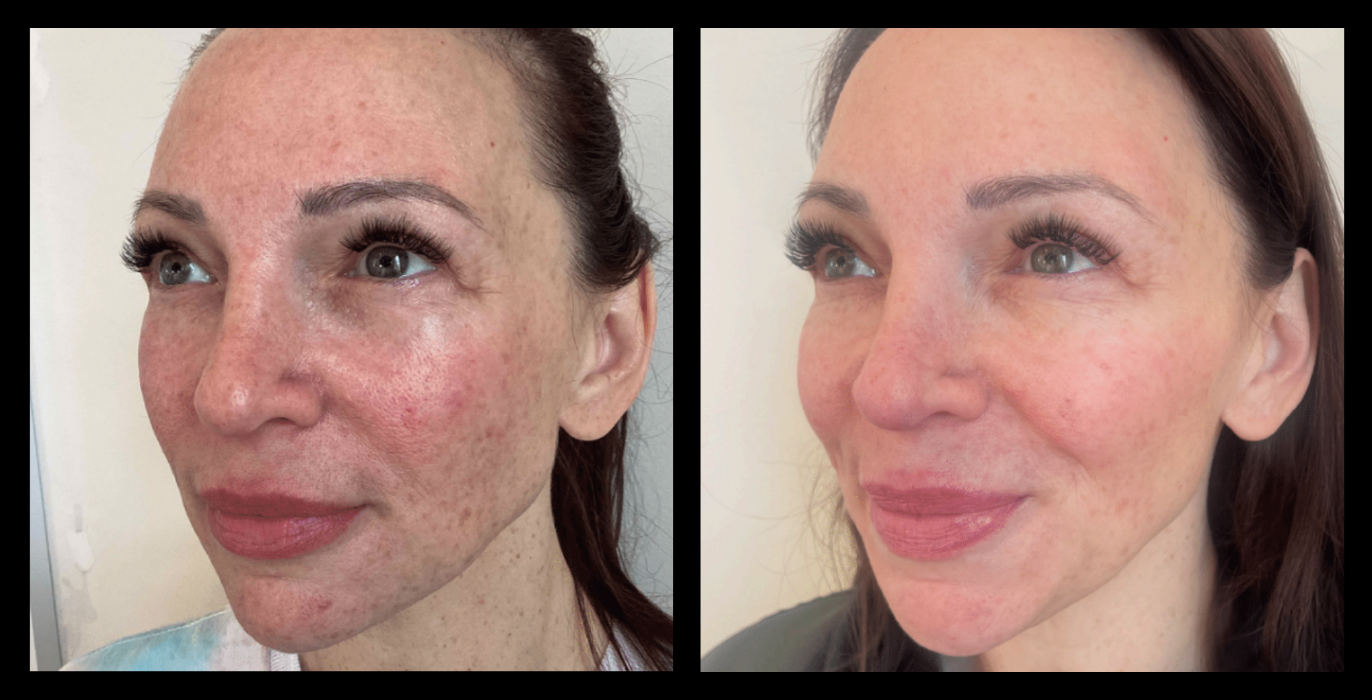 Before and after results of skin resurfacing and lifting treatment on the face, highlighting smoother skin texture, reduced fine lines, and lifted facial contours after 1 session. Photo courtesy of Youthful by Rosie, Brighton, VIC.