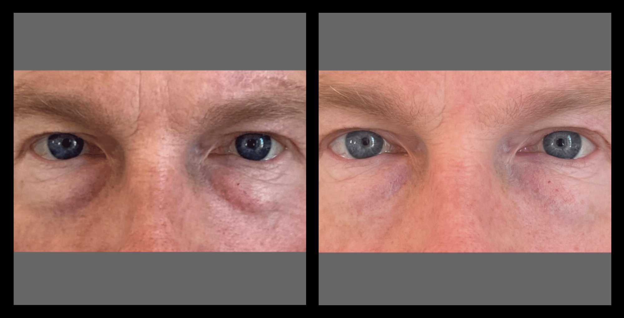 Under-eye transformation after 4 skin resurfacing and lifting treatments, showing reduced puffiness, smoother texture, and fewer fine lines. Results courtesy of Youthful by Rosie, Brighton, VIC. Ideal for clients seeking non-invasive under-eye rejuvenation.
