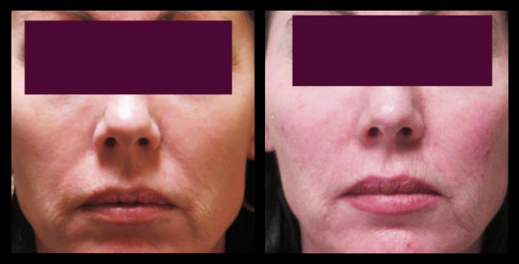 Before and after comparison of Thuzzle Double Wave treatment results after 6 sessions showing visible skin tightening and improved facial contour. Image courtesy of GMV, Italy.