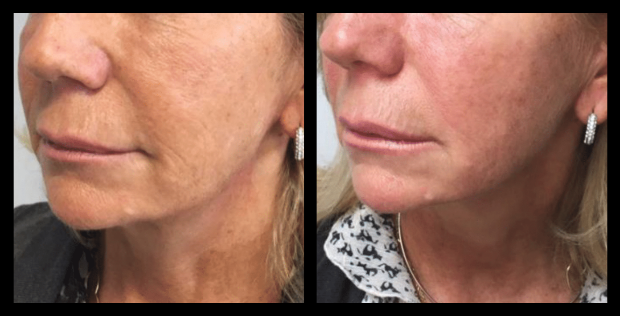 Before and after results showing enhanced skin texture and reduced fine lines following 2 Thuzzle Fractional Radial treatments. Image courtesy of GMV. Effective non-invasive fractional radiofrequency treatment for skin rejuvenation and collagen stimulation.