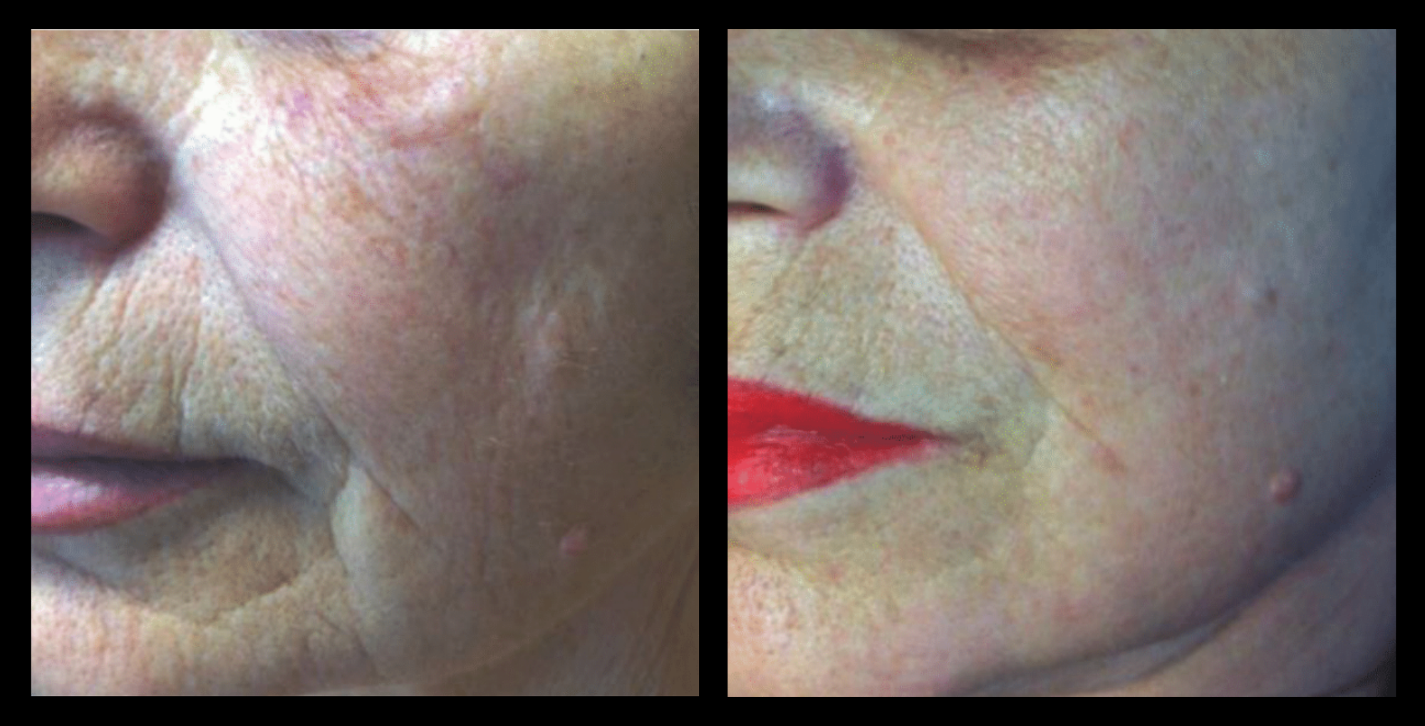 Before and after results showing enhanced skin texture and reduced fine lines following 2 Thuzzle Fractional Radial treatments. Image courtesy of GMV. Effective non-invasive fractional radiofrequency treatment for skin rejuvenation and collagen stimulation.