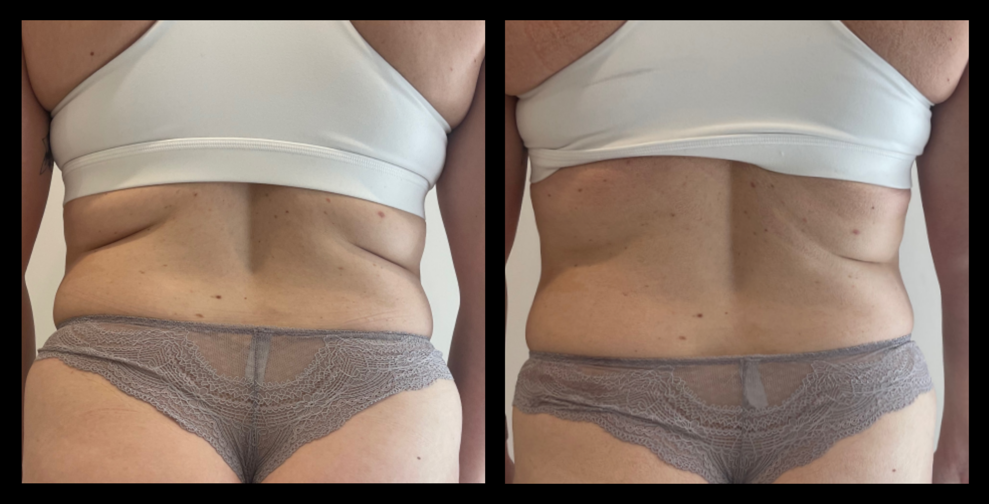 Visible fat reduction and improved skin tone after 1 Thuzzle Lipolysis treatment, focusing on non-invasive body contouring. Results courtesy of Taut Face and Body, Beeliar, WA. Ideal for clients seeking targeted fat loss and smoother contours.
