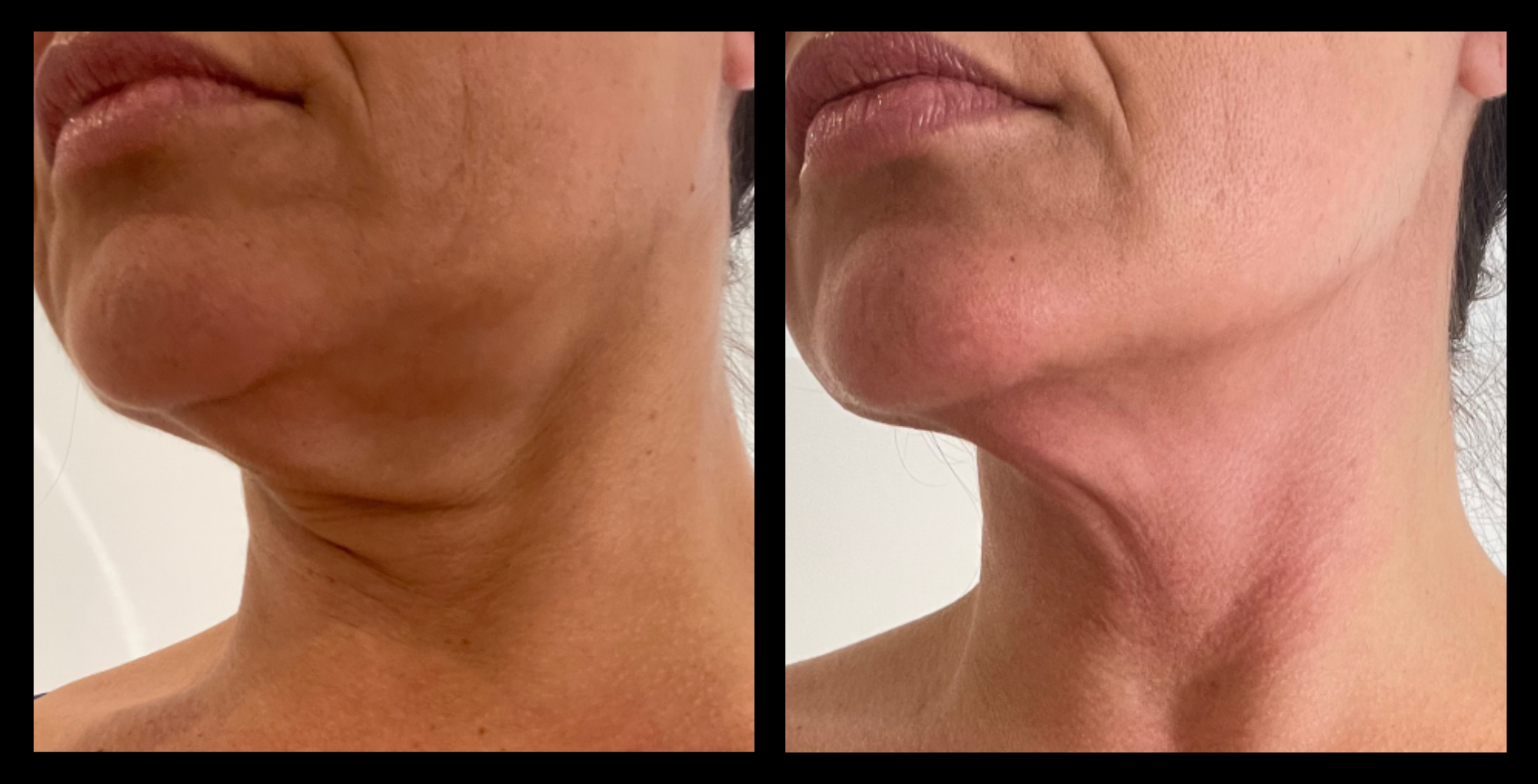Visible fat reduction and improved skin tone after 1 Thuzzle Lipolysis treatment, focusing on non-invasive body contouring. Results courtesy of Taut Face and Body, Beeliar, WA. Ideal for clients seeking targeted fat loss and smoother contours.