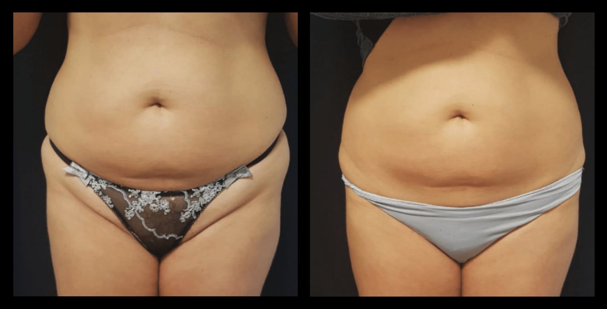 Before and after image showing visible skin tightening and improved tone after 4 Thuzzle Tetrawave treatments. Courtesy of GMV. Non-invasive Tetrawave RF technology for effective skin firming and collagen boosting results.
