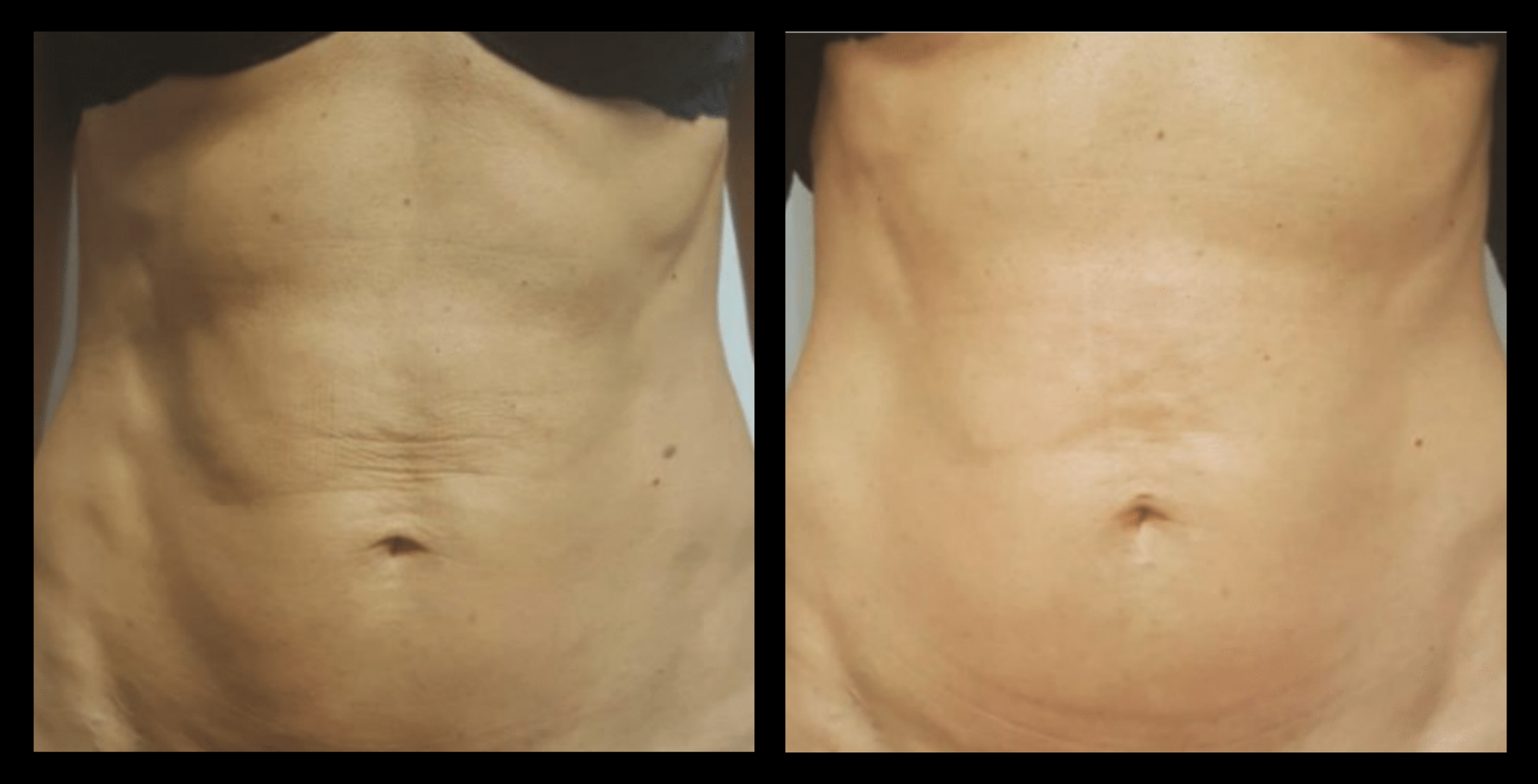 Before and after image showing visible skin tightening and improved tone after 4 Thuzzle Tetrawave treatments. Courtesy of GMV. Non-invasive Tetrawave RF technology for effective skin firming and collagen boosting results.