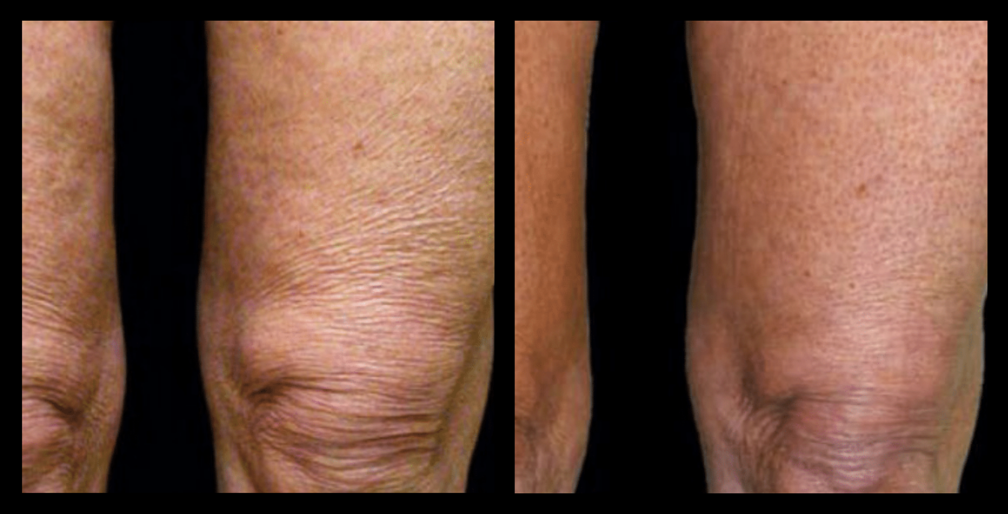 Before and after results of Thuzzle Tetrawave treatment showing noticeable skin firmness and contour improvement after 1 session. Image courtesy of GMV. Effective radiofrequency skin tightening solution with visible results.