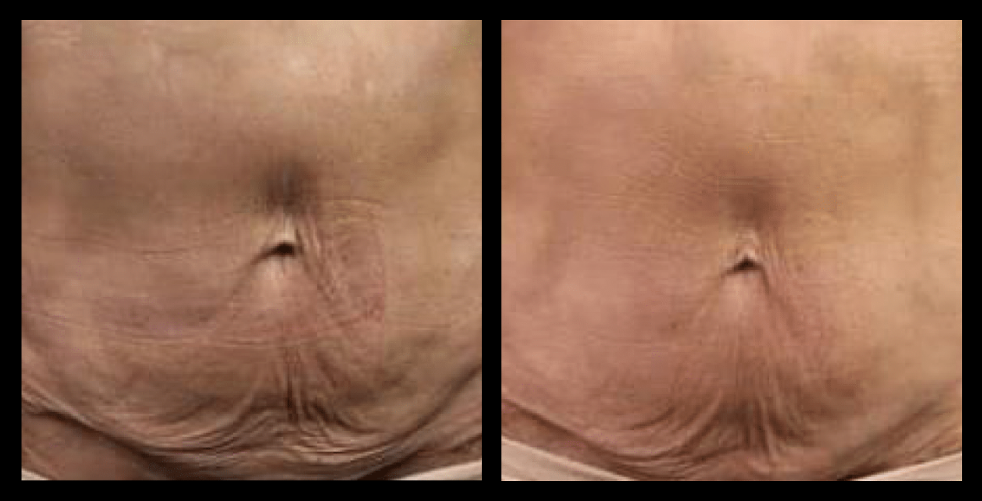 Before and after Thuzzle Tetrawave treatment results showing visible skin tightening and facial contour improvement after 1 session – GMV, Italy.