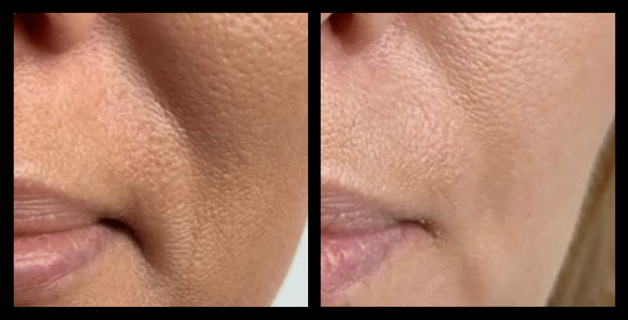 Before and after Thuzzle Tetrawave treatment results showing improved skin texture and visible lifting effect after one session. Image courtesy of GMV. Non-invasive radiofrequency treatment for skin rejuvenation and tightening.