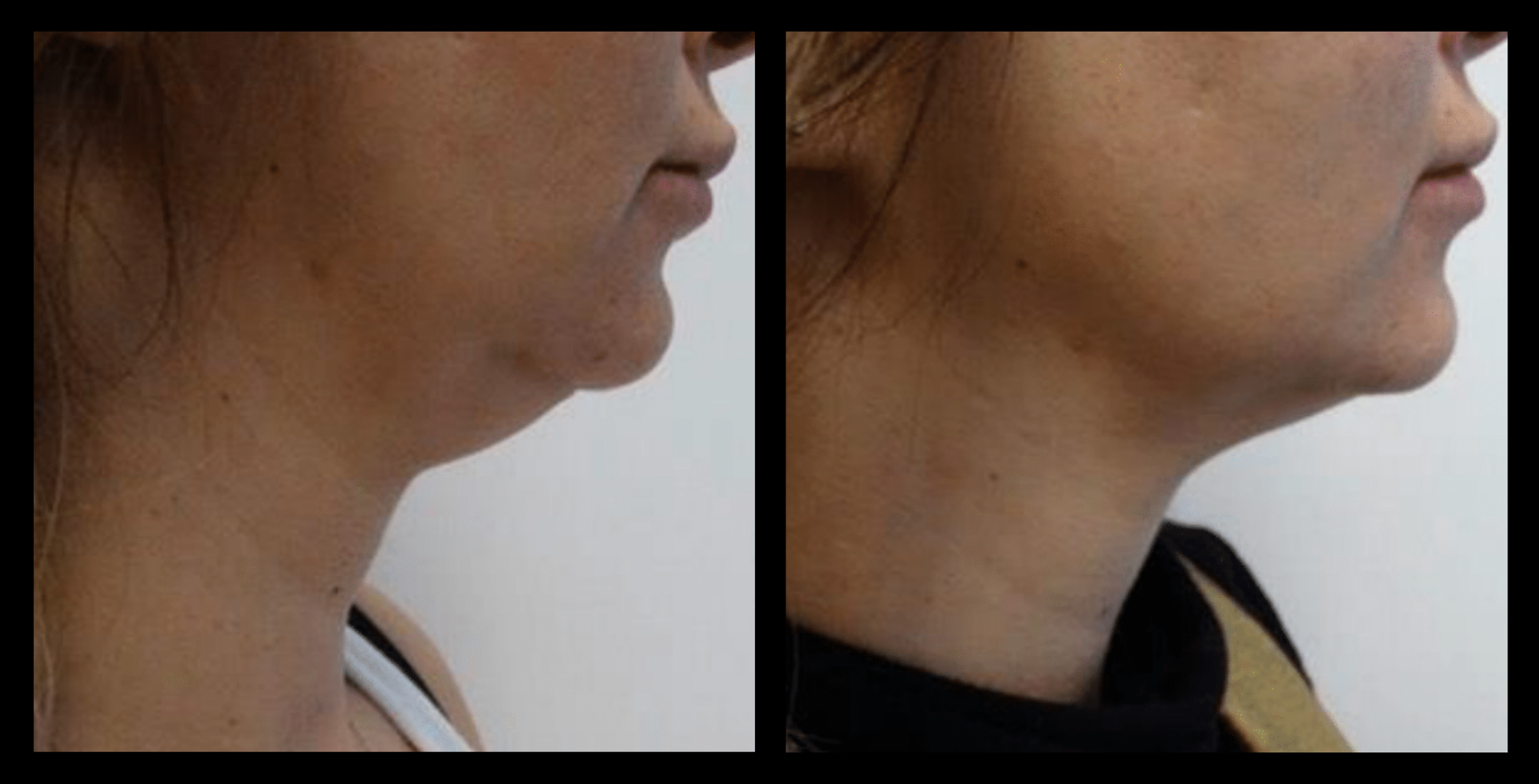 Before and after results of Thuzzle Tetrawave treatment targeting double chin reduction. Visible improvement in jawline contour and skin firmness. Image courtesy of GMV. Ideal for non-invasive fat reduction and skin tightening under the chin.