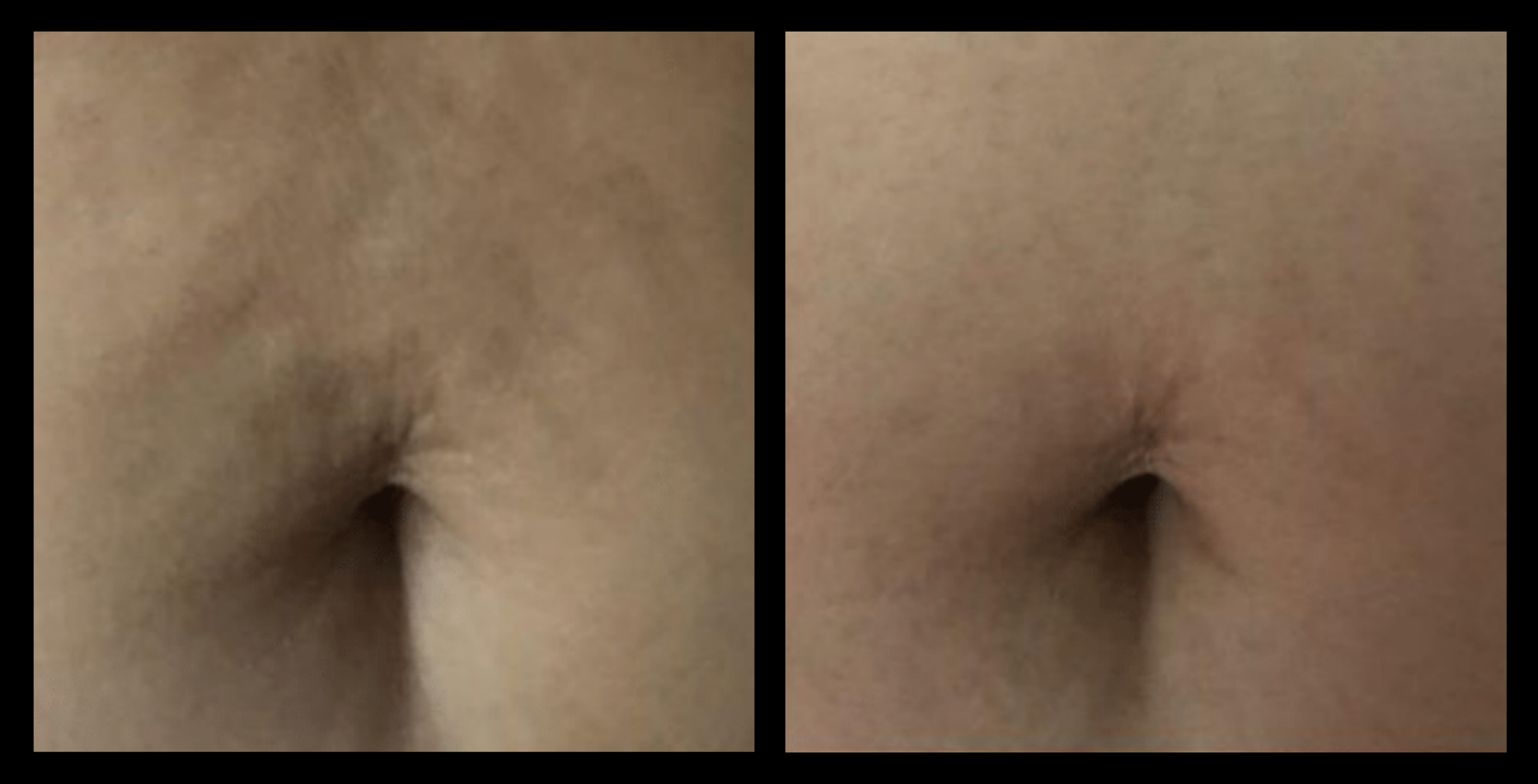 Dramatic facial skin firming and contour improvement after 6 Thuzzle Tetrawave treatments – before and after comparison by GMV, Italy.