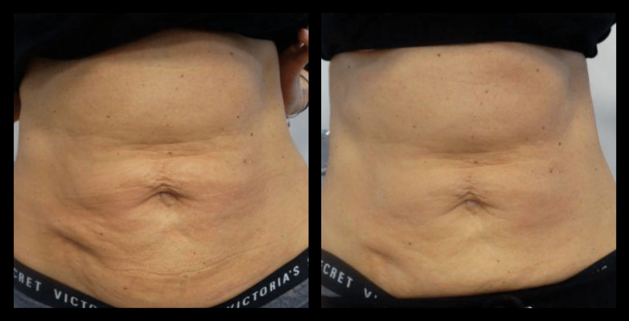 Before and after Thuzzle Tetrawave treatment results showing visible skin tightening and facial contour improvement after 1 session – GMV, Italy.