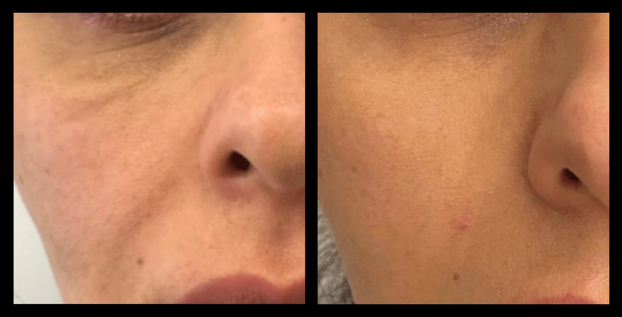 Before and after Thuzzle Tetrawave treatment showing visible reduction in sagging under-eye skin and softening of smile lines. Non-surgical skin tightening and rejuvenation results after one session. Photo courtesy of GMV. Ideal for targeting signs of aging and improving facial firmness.