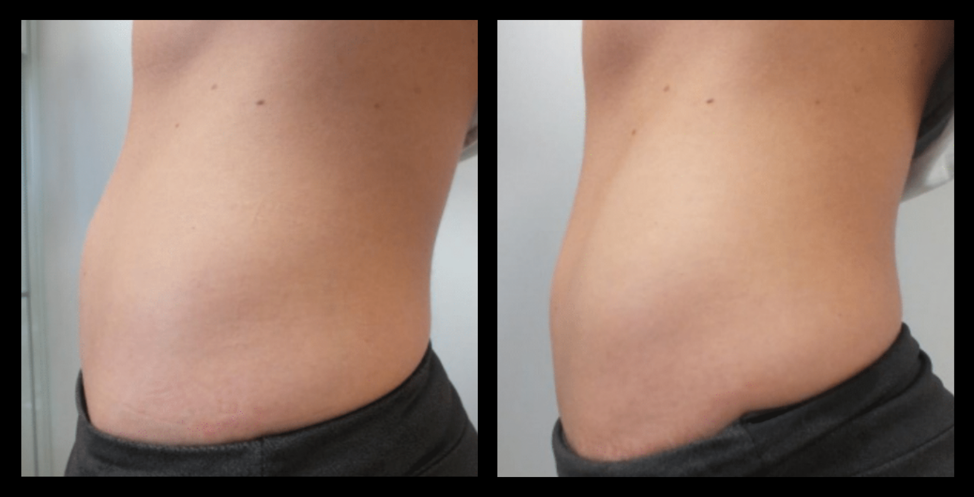 Visible under-eye tightening and wrinkle reduction after 1 Thuzzle Tetrawave treatment – before and after results by GMV, Italy.