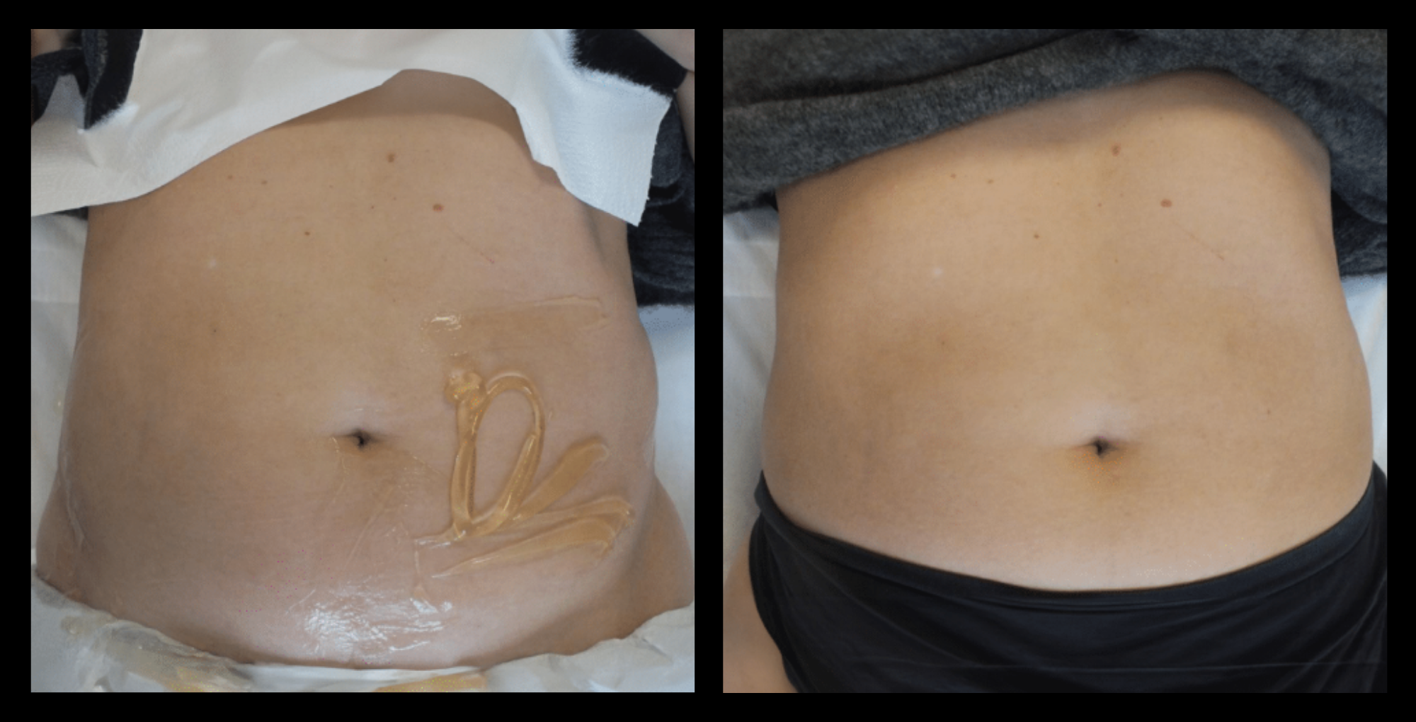 Visible under-eye tightening and wrinkle reduction after 1 Thuzzle Tetrawave treatment – before and after results by GMV, Italy.