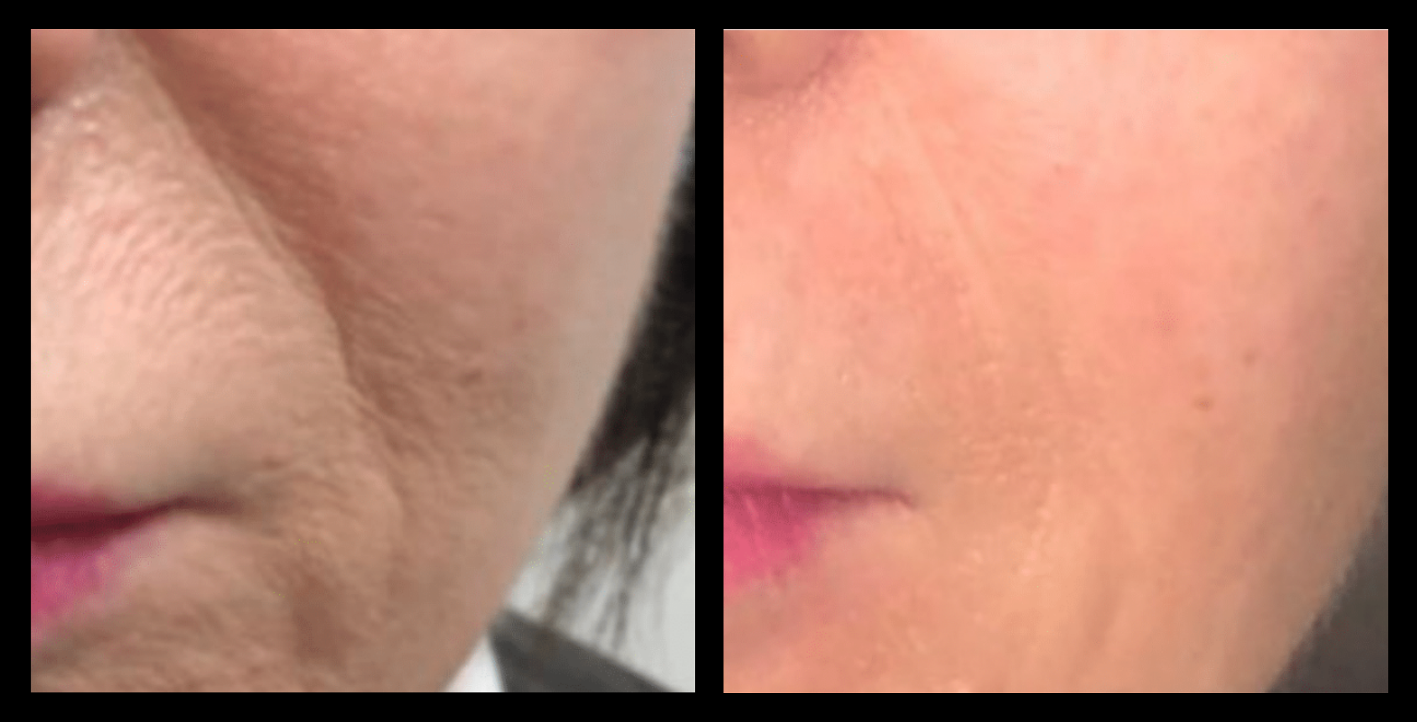 Before and after Thuzzle Tetrawave treatment results focused on reducing smile lines. Visible skin rejuvenation and softening of nasolabial folds after a non-invasive facial treatment. Photo courtesy of GMV.
