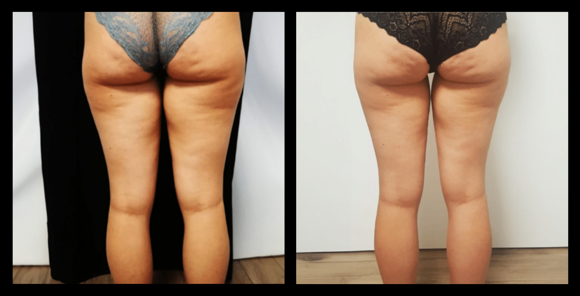 Double Wave treatment before and after results after 2 sessions showing improved skin firmness and facial contour. Photo courtesy of GMV.