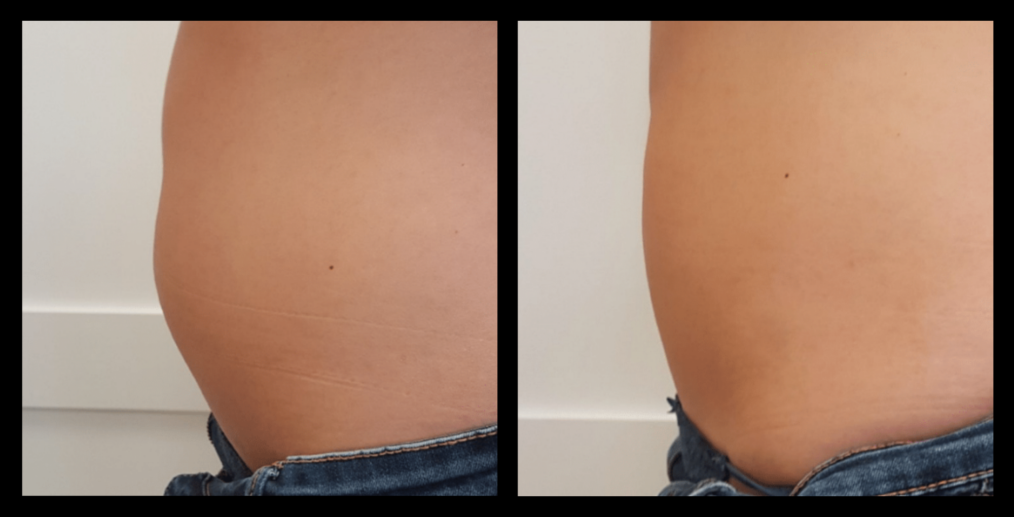 Before and after results of Thuzzle Tetrawave treatment on abdominal fat. Visible reduction in belly fat and improved skin firmness after a non-invasive body contouring session. Photo courtesy of GMV.