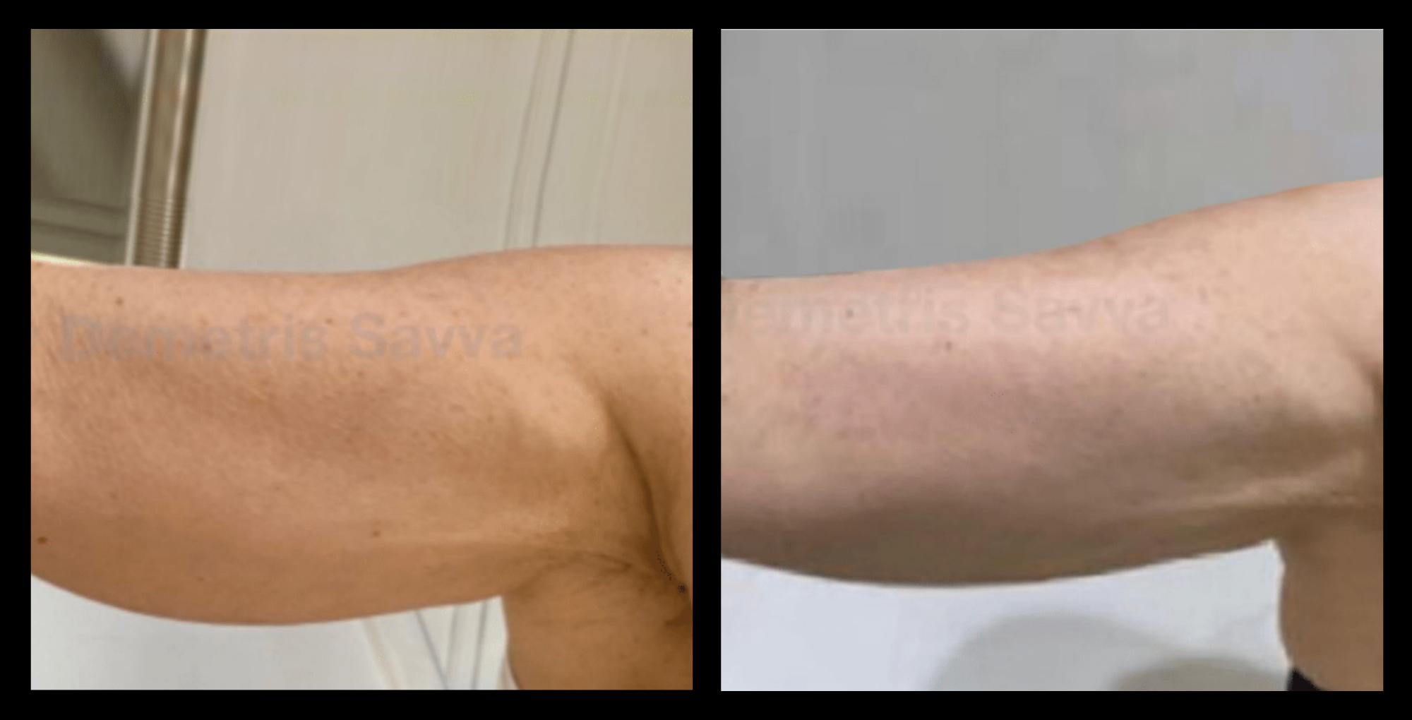 Before and after Thuzzle Tetrawave treatment on arms showing visible fat reduction and skin tightening after 3 sessions. Non-invasive arm contouring results. Photo courtesy of GMV, Italy.