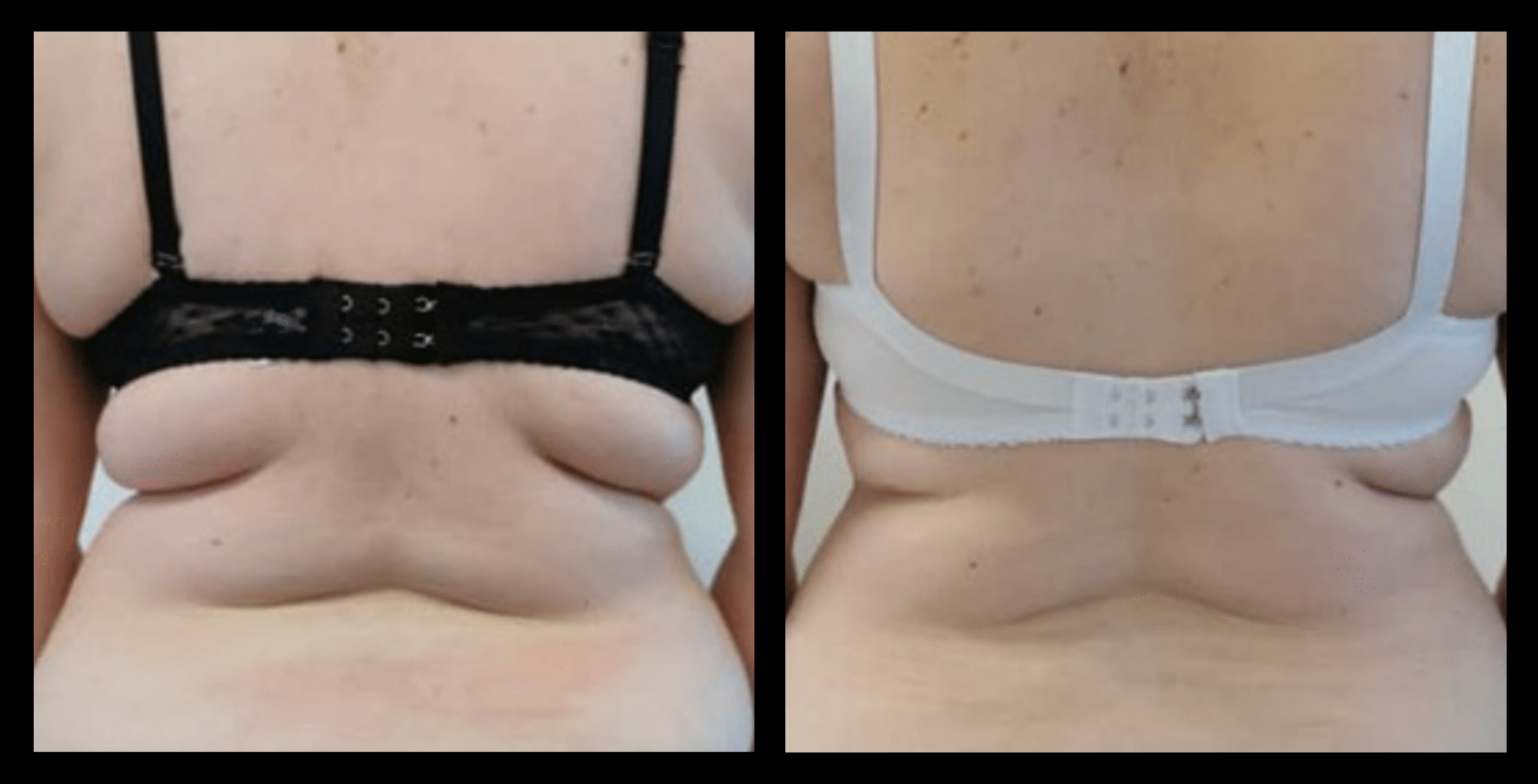 Before and after Thuzzle Tetrawave treatment targeting back fat, showing noticeable fat reduction and improved skin firmness after 4 sessions. Effective non-surgical back contouring results. Photo courtesy of GMV, Italy.