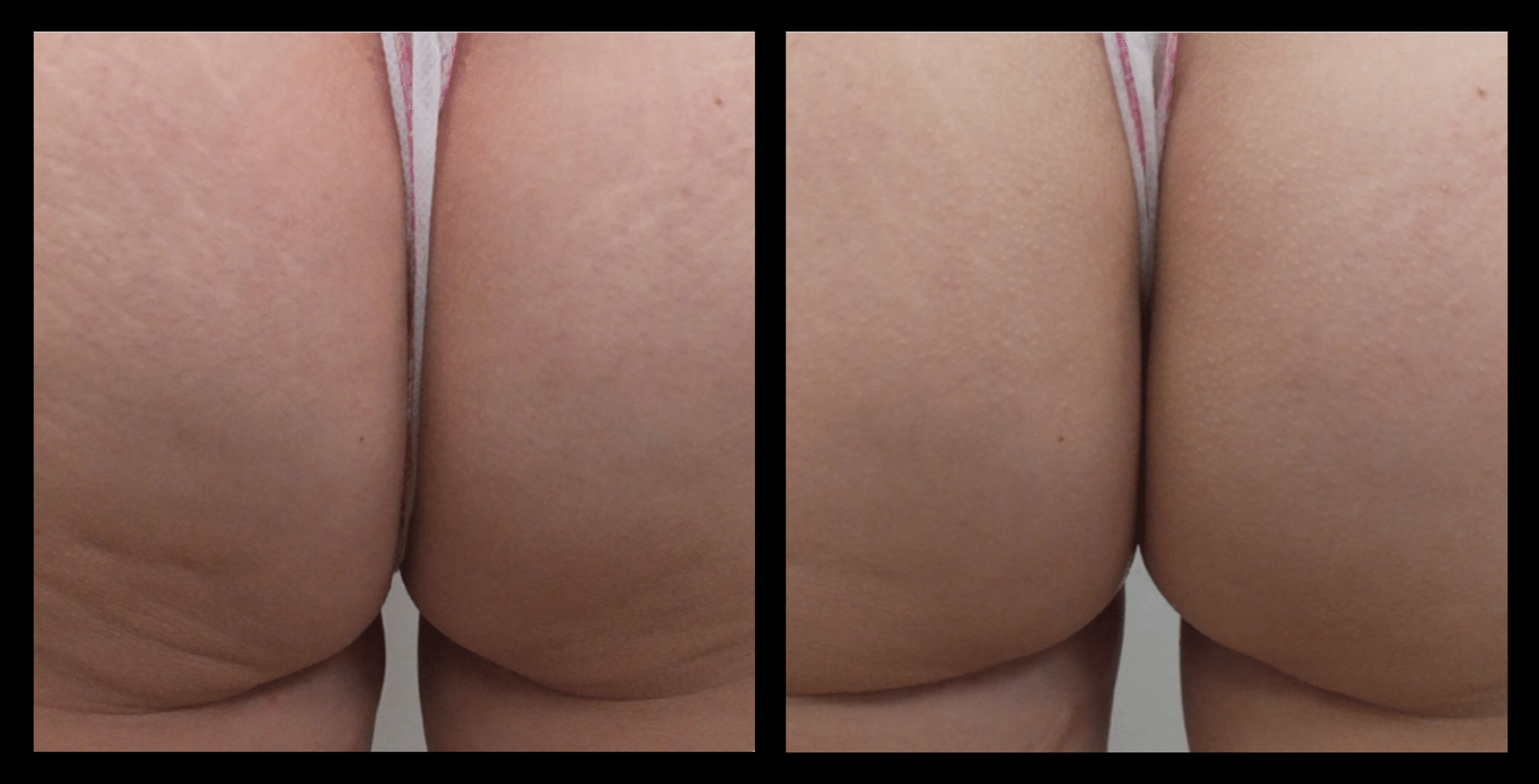 Before and after Thuzzle Tetrawave treatment targeting buttocks fat, showing noticeable reduction and skin firming after 4 treatments. Non-surgical body contouring for buttocks. Photo courtesy of GMV, Italy.