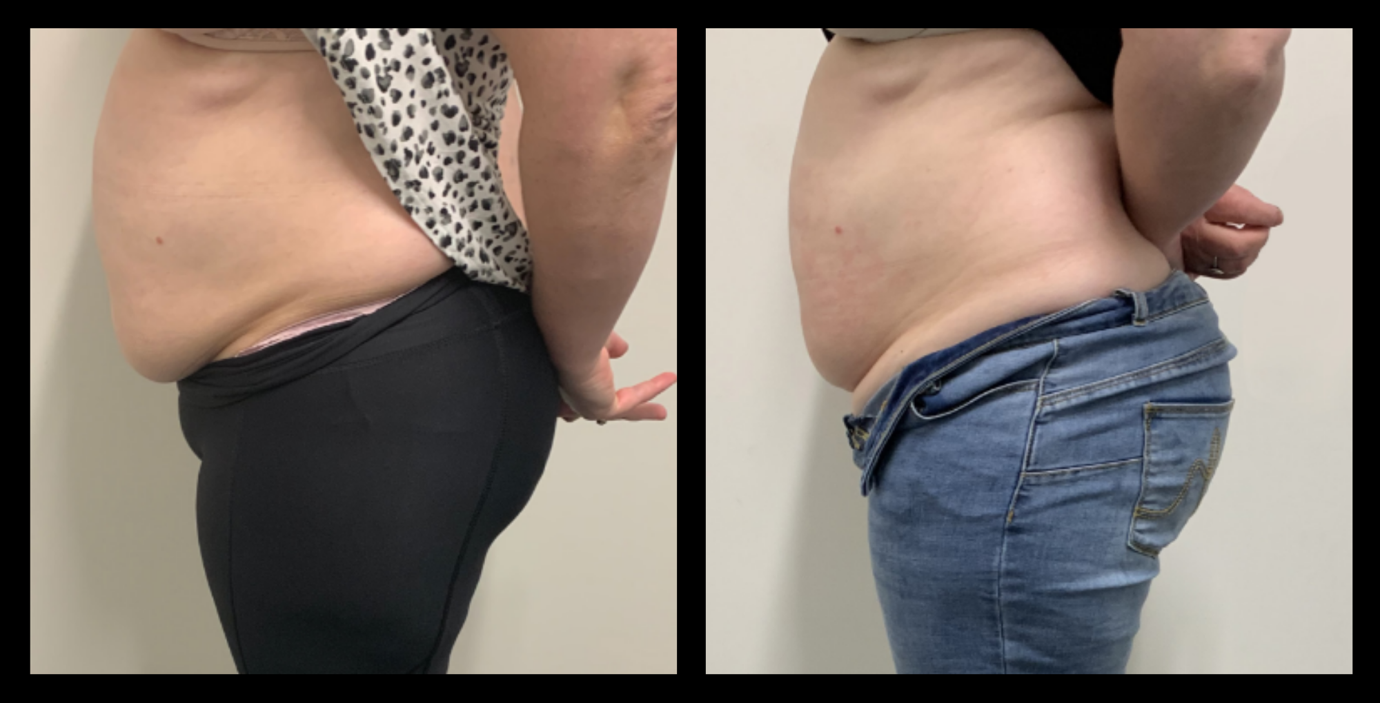 Before and After 3 Treatments of Ultrasound Body Contouring and Radio Frequency Skin Tightening – Non-Invasive Body Contouring Results by Body Refine Body Contouring.