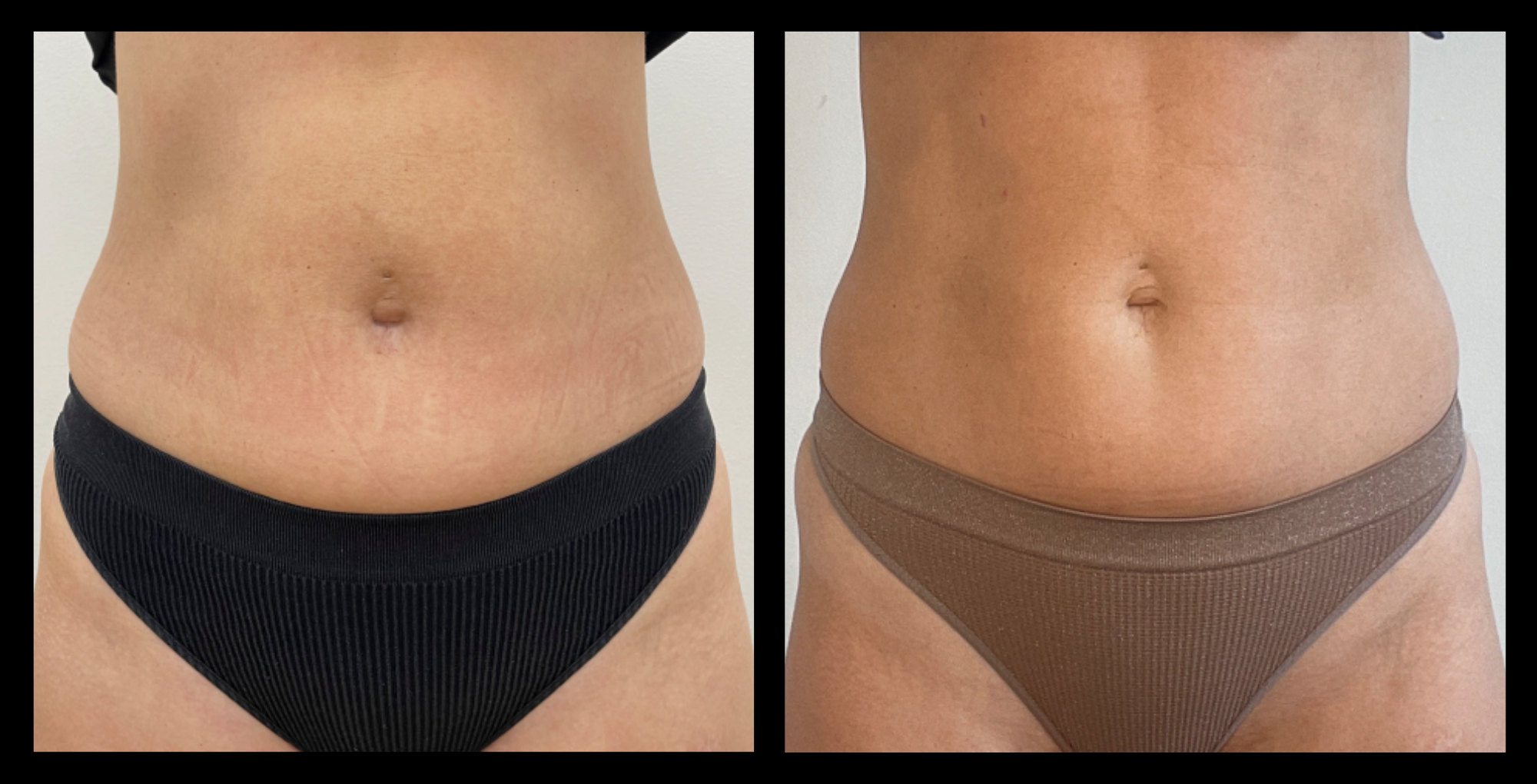 Before and after results showing noticeable improvement in body contour and reduced fat visibility after 4 vascularization and lipolysis treatments. Enhanced tone and circulation achieved at Youthful by Rosie, Brighton, VIC.