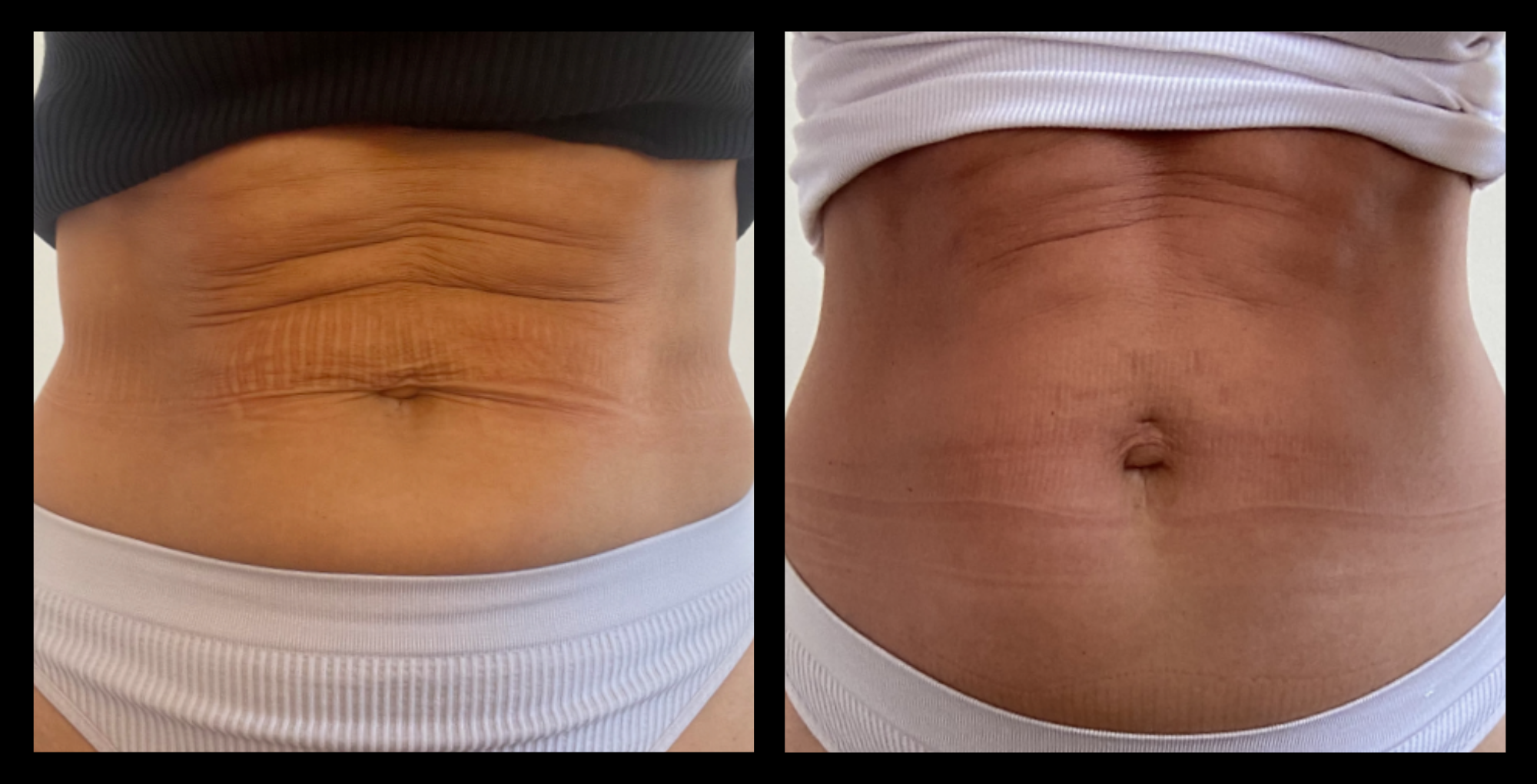 Before and after image showing visible improvements in vascularization and fat reduction after 6 targeted body contouring treatments. Enhanced circulation and slimmer appearance. Photo courtesy of Youthful by Rosie, Brighton, VIC.